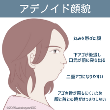 アデノイド顔貌