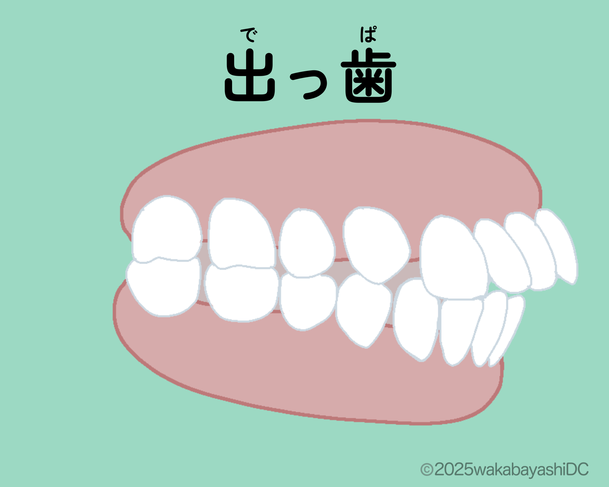 出っ歯