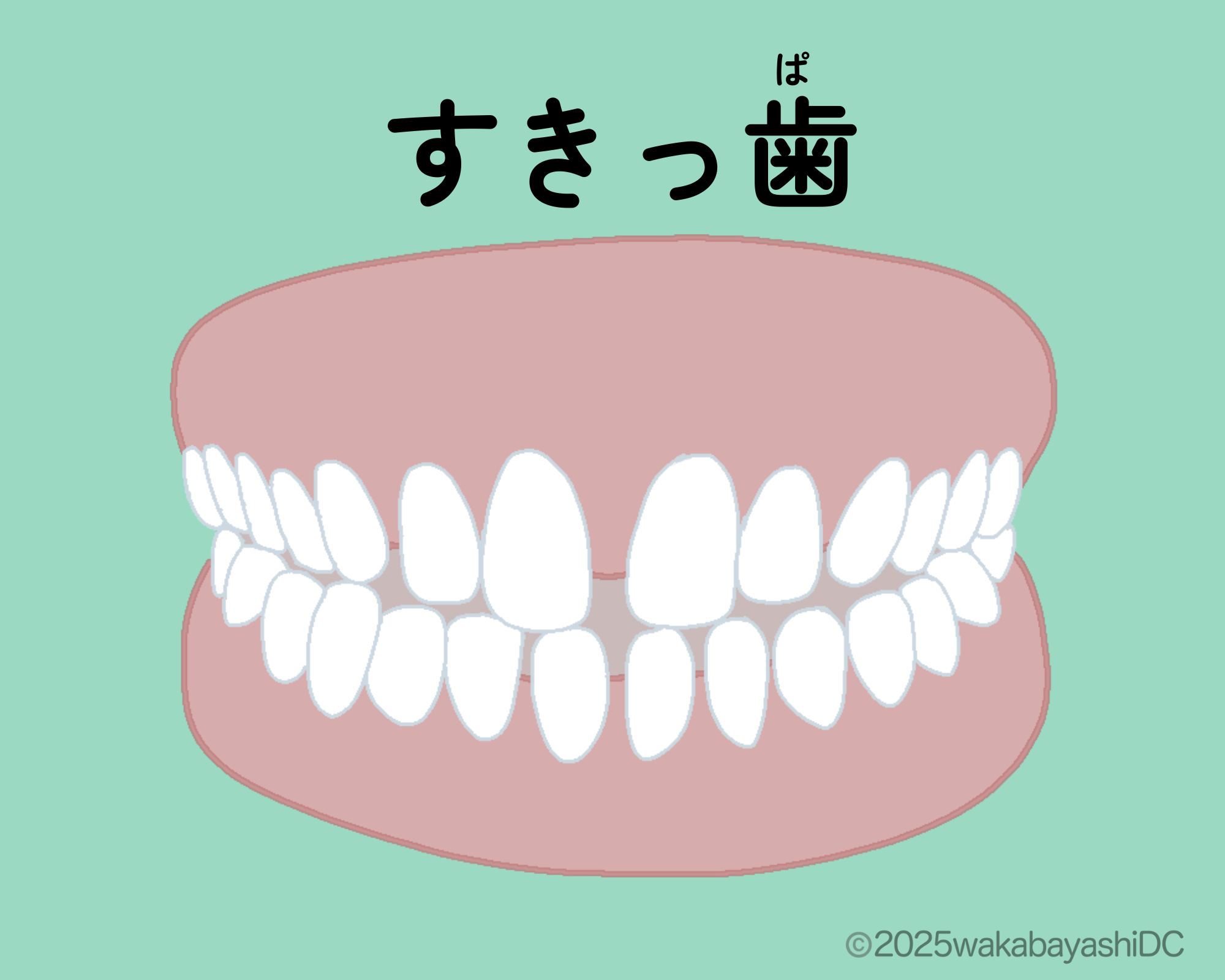 すきっ歯
