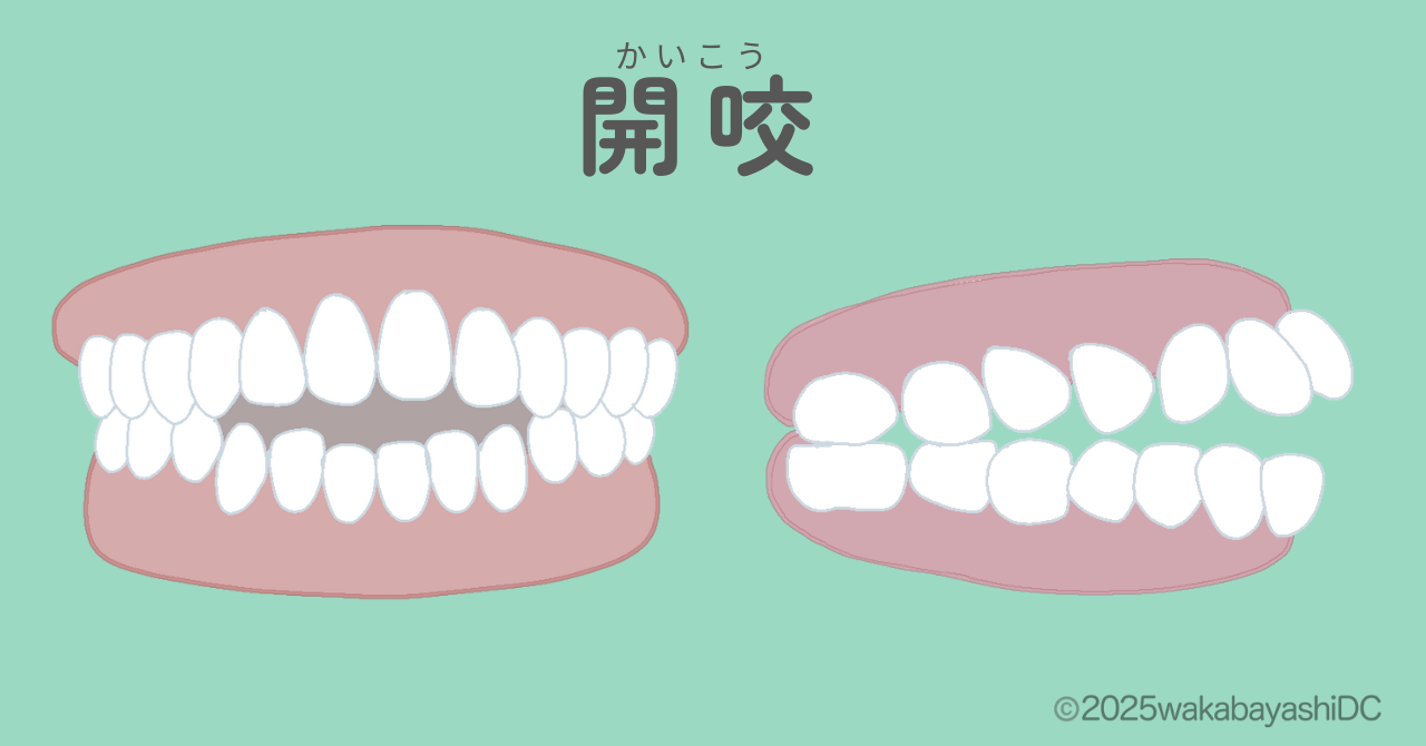 開咬