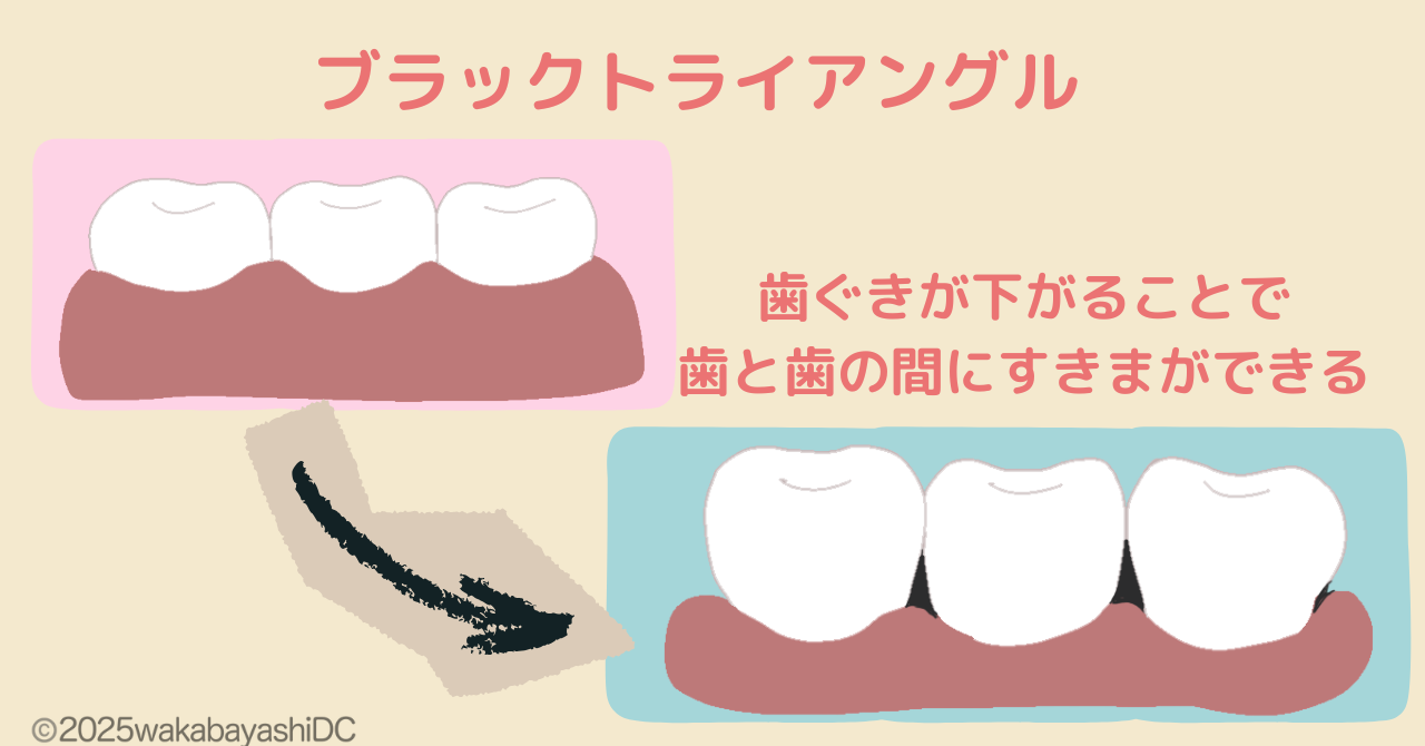 ブラックトライアングル