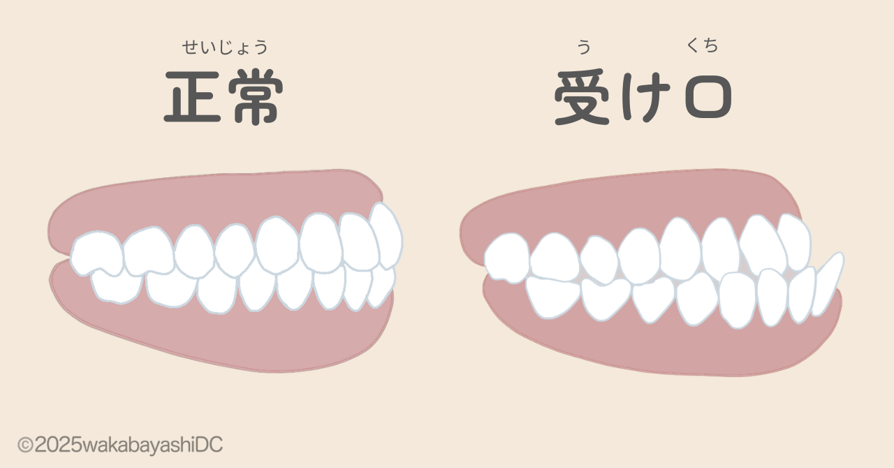 受け口とは