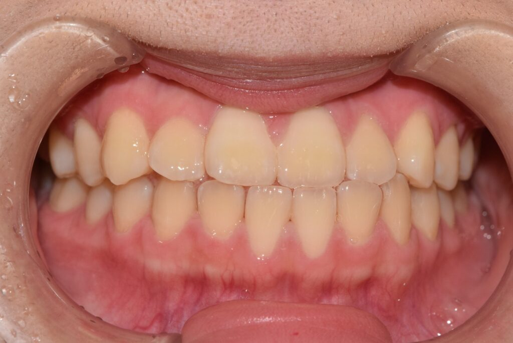 受け口の矯正治療(インビザライン)