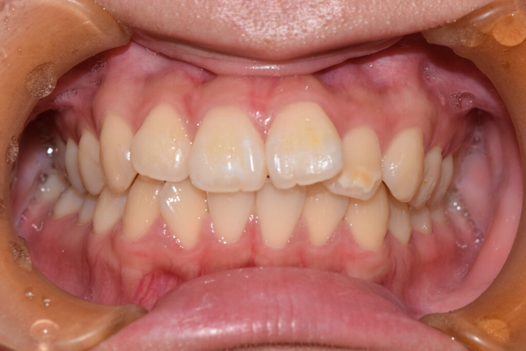 叢生の矯正治療(インビザライン)