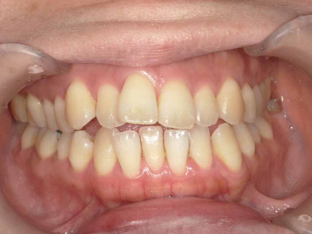 出っ歯・開咬の矯正治療(インビザライン)