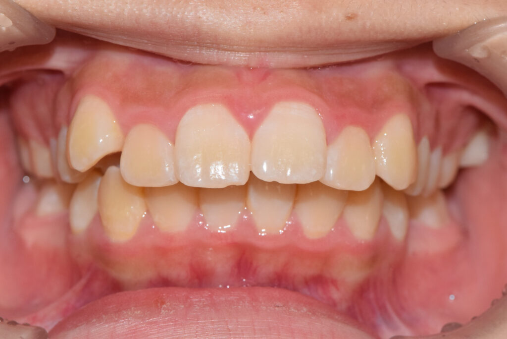 出っ歯・開咬の矯正治療(インビザライン)