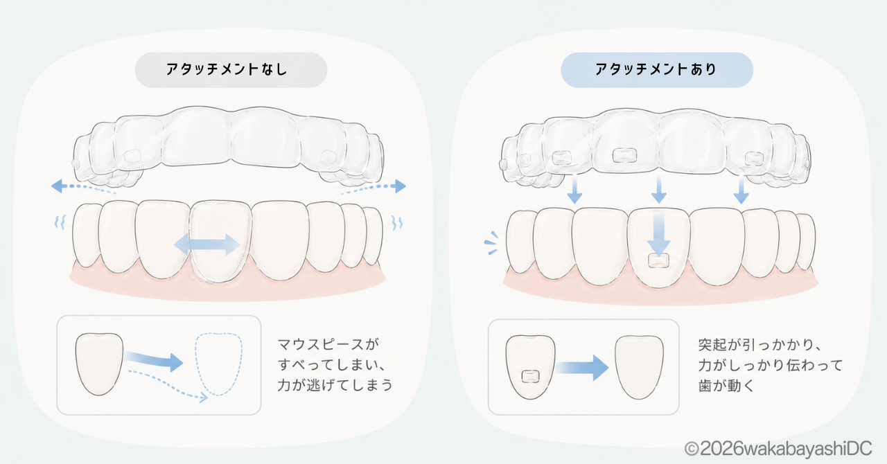 インビザラインのアタッチメント