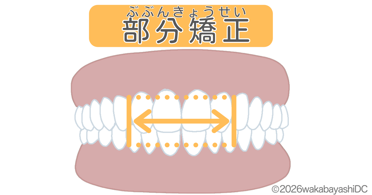 前歯だけのマウスピース矯正