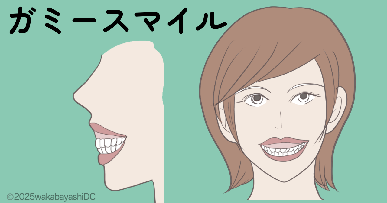 ガミースマイル
