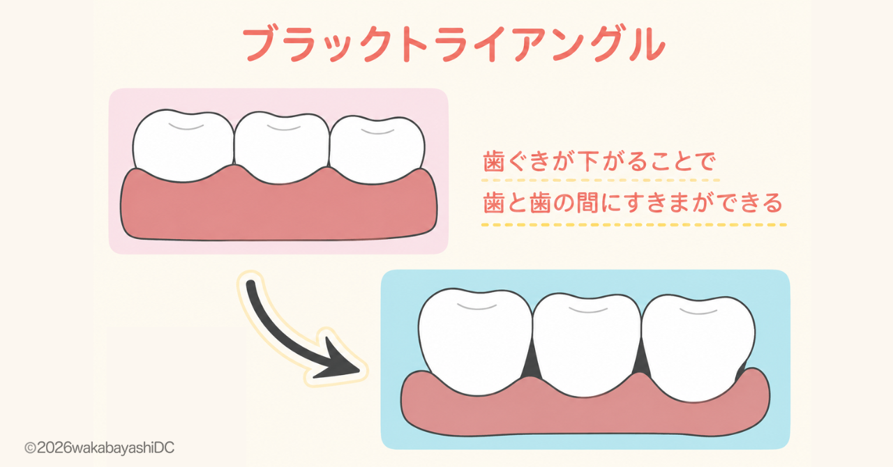 ブラックトライアングル