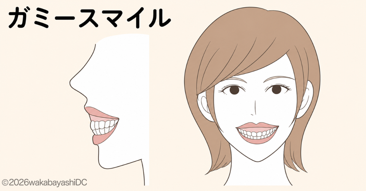ガミースマイル