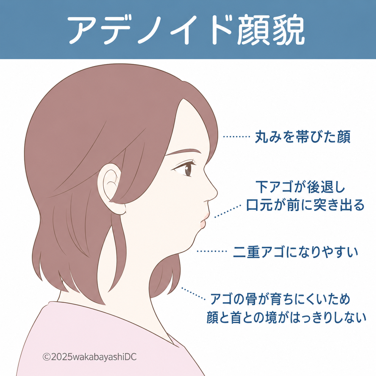 アデノイド顔貌