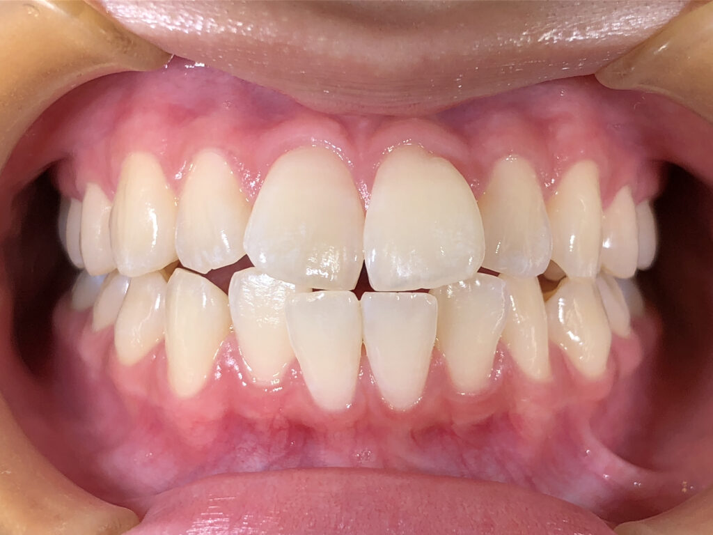 叢生の矯正治療(インビザライン)