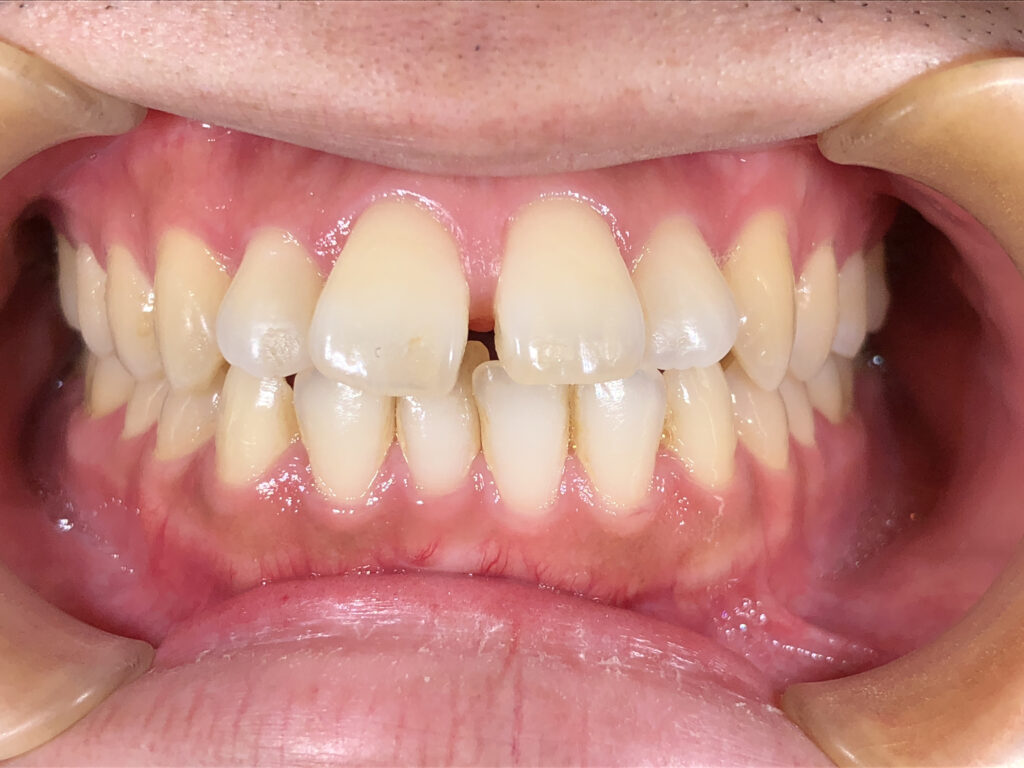 すきっ歯の矯正治療(インビザライン)