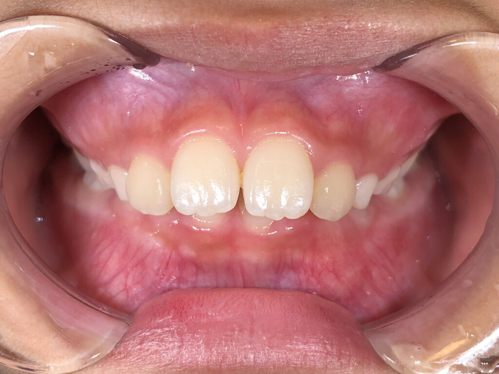 出っ歯・叢生の矯正治療(インビザラインファースト)