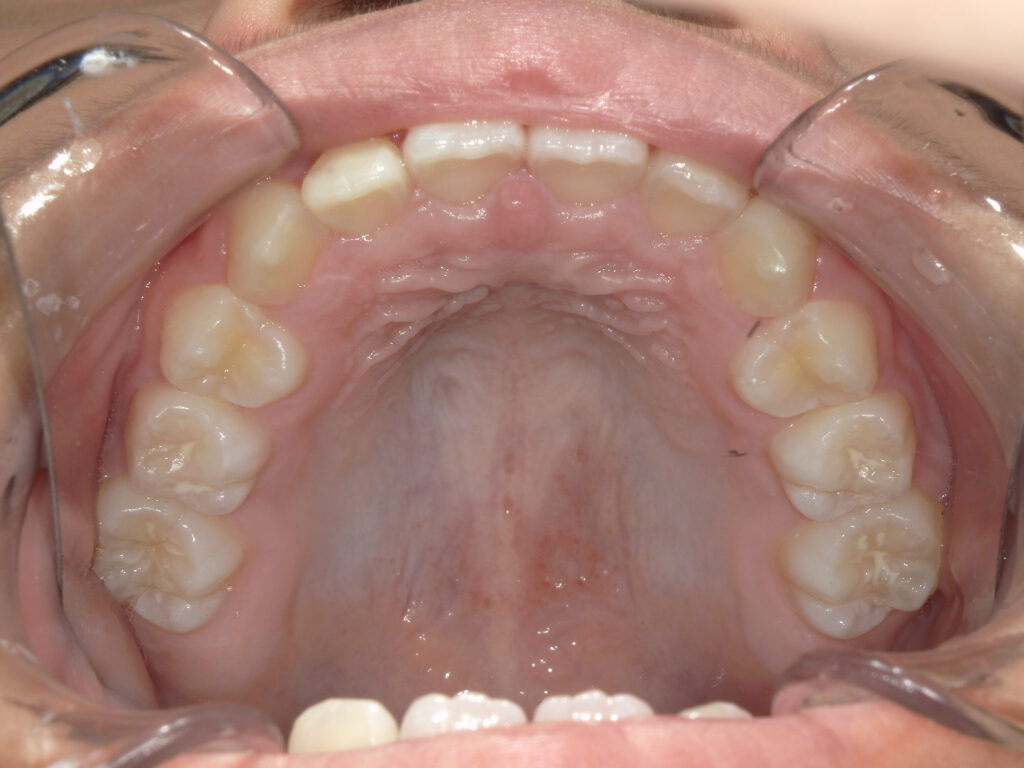 保定中経過(1年後)