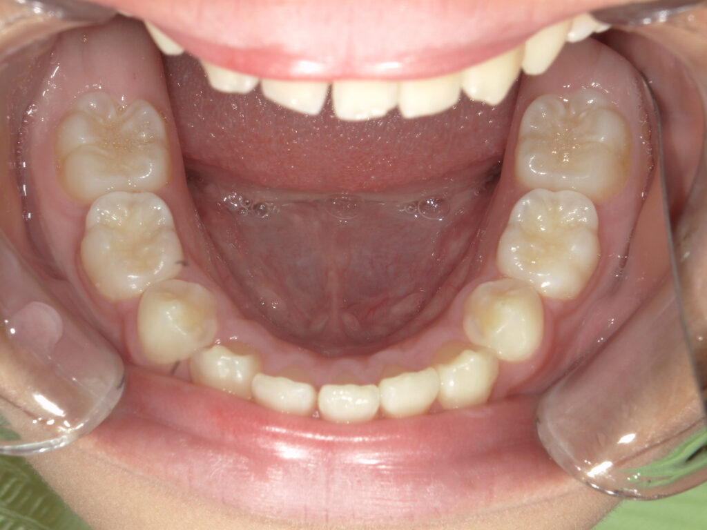 保定中経過(1年後)