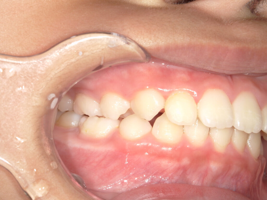 保定中経過(1年後)