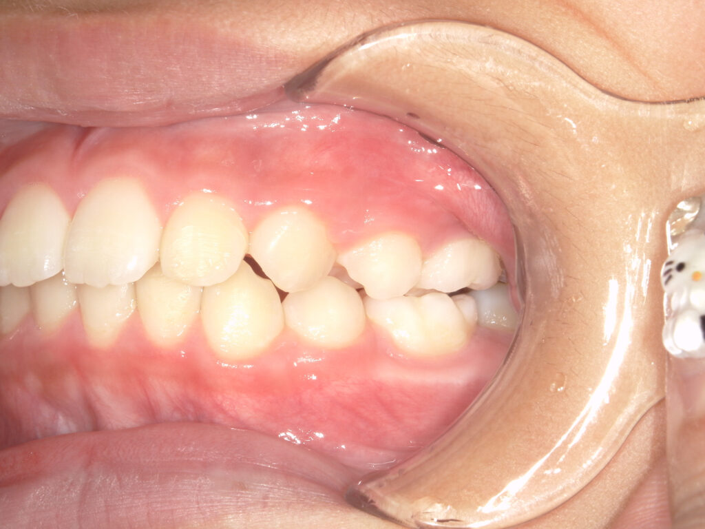 保定中経過(1年後)