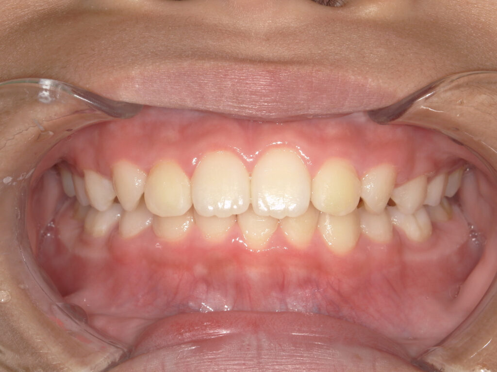 保定中経過(1年後)