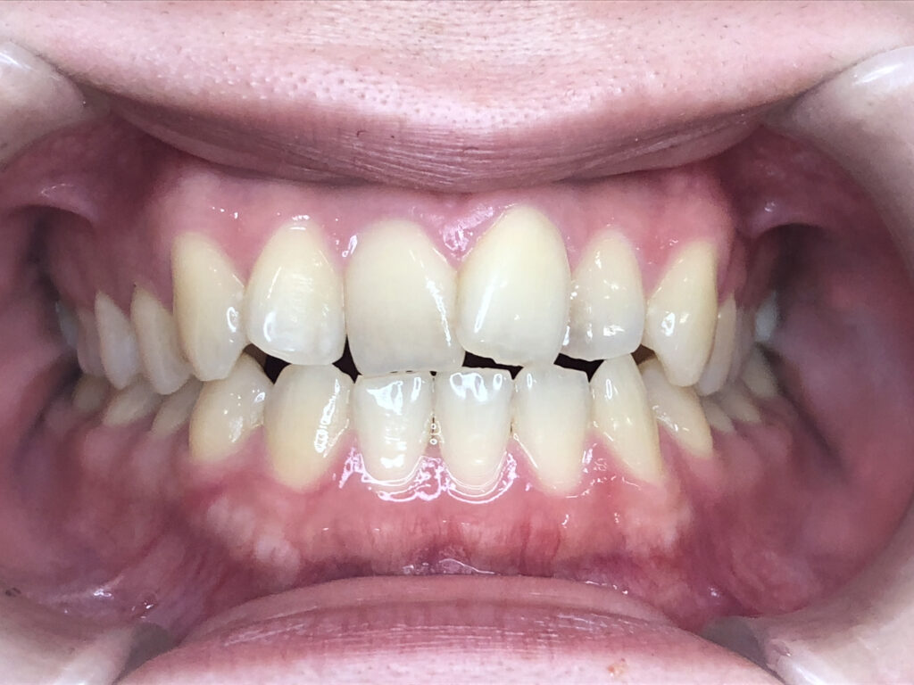 叢生の矯正治療(インビザライン)