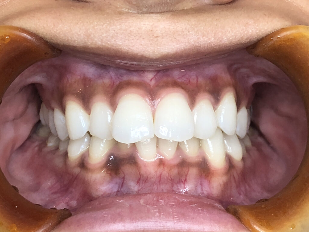 叢生の矯正治療(インビザライン)