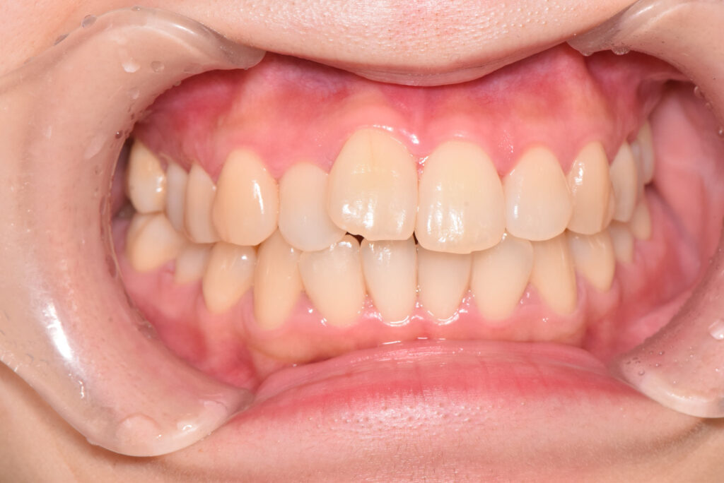 出っ歯・叢生の矯正治療(インビザライン)