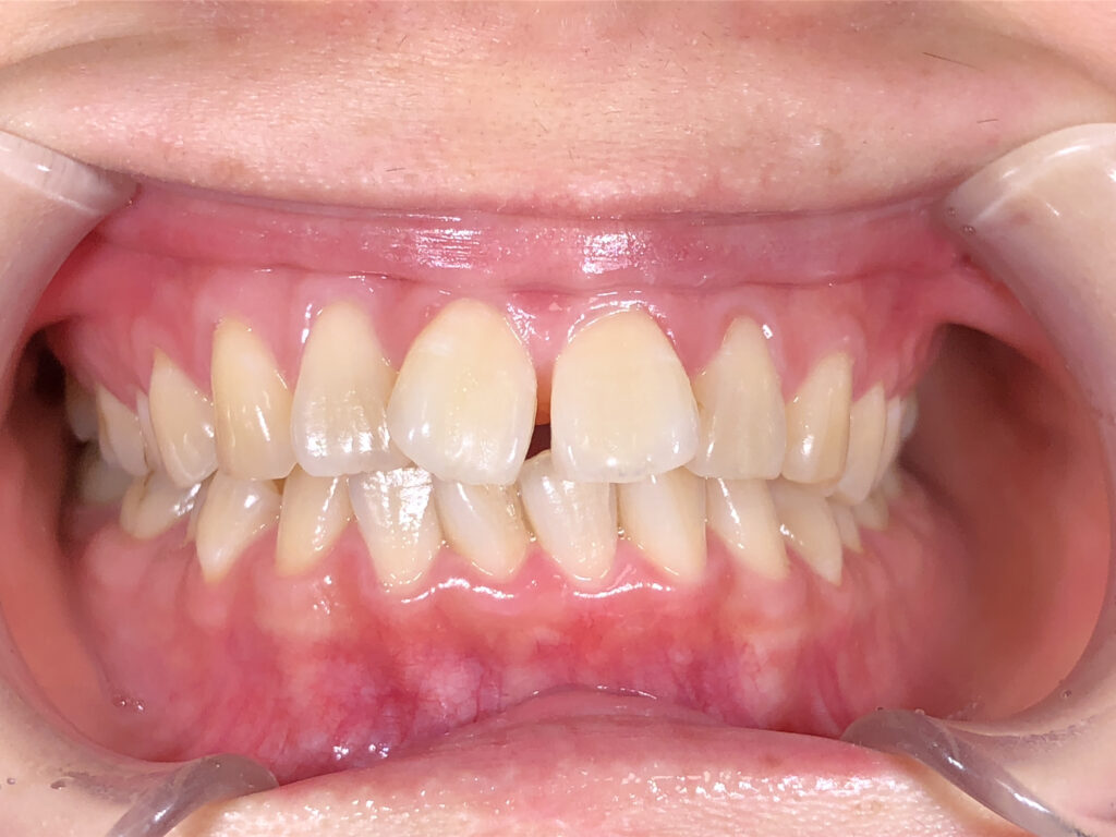 すきっ歯の矯正治療(インビザライン)