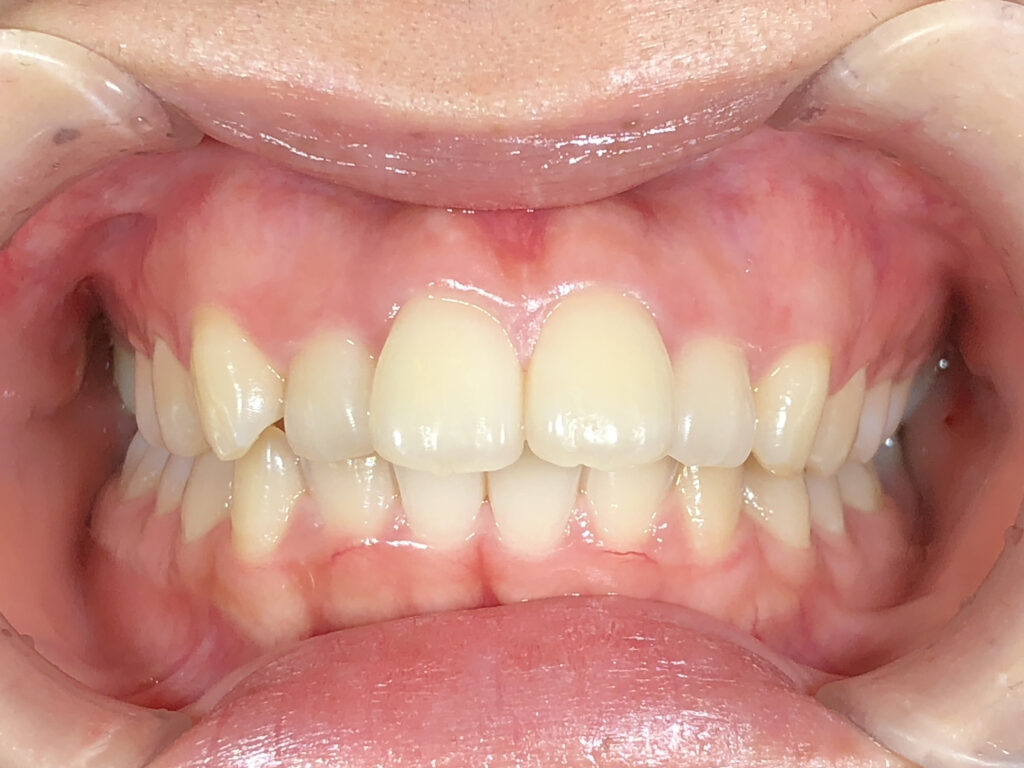 出っ歯・叢生の矯正治療(インビザライン)