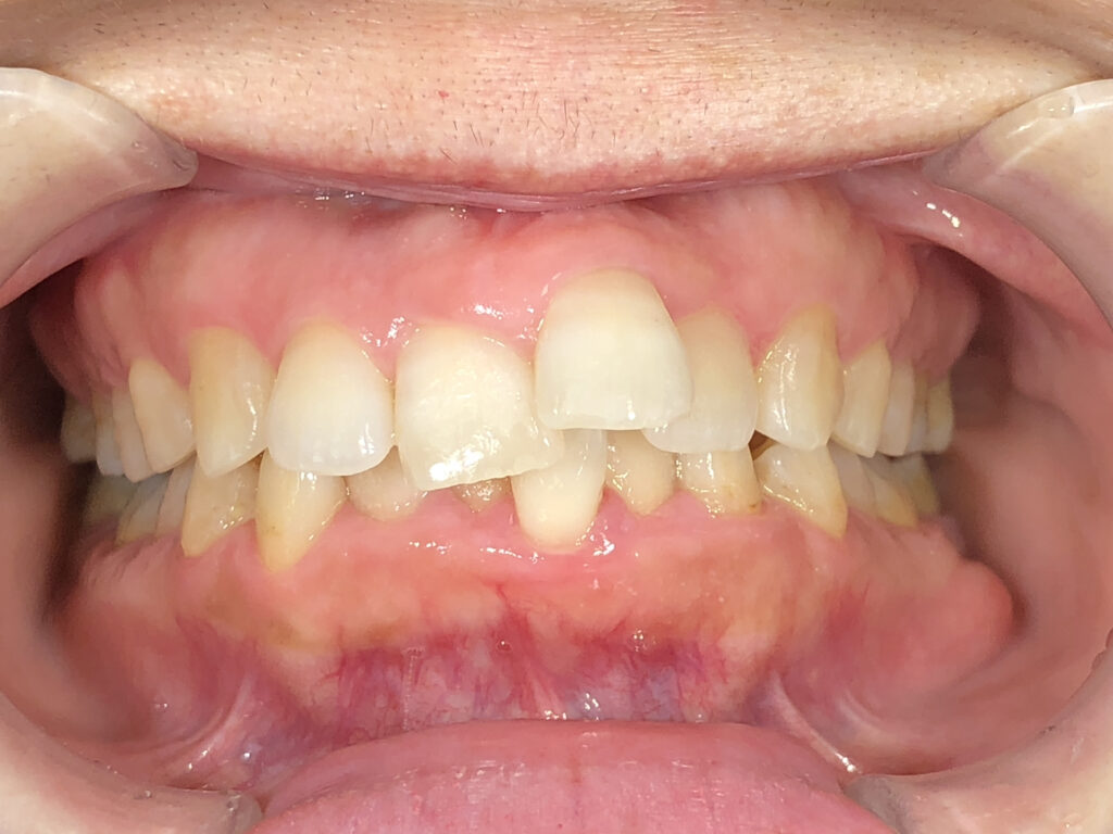 出っ歯・叢生の矯正治療(インビザライン)