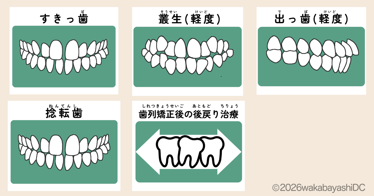 前歯だけのマウスピース矯正
