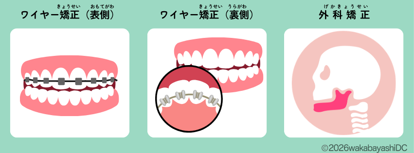 マウスピース矯正ができない場合の代替手段