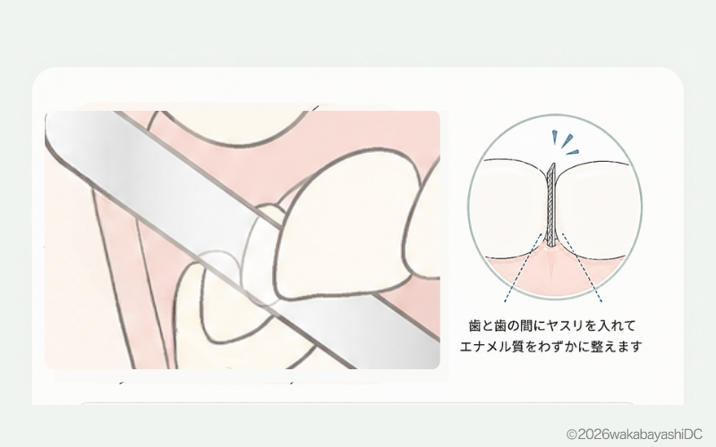 インビザラインで歯を削る