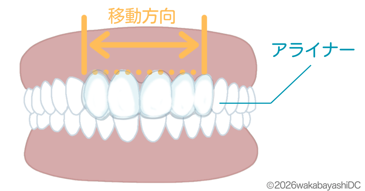 マウスピース矯正で部分矯正