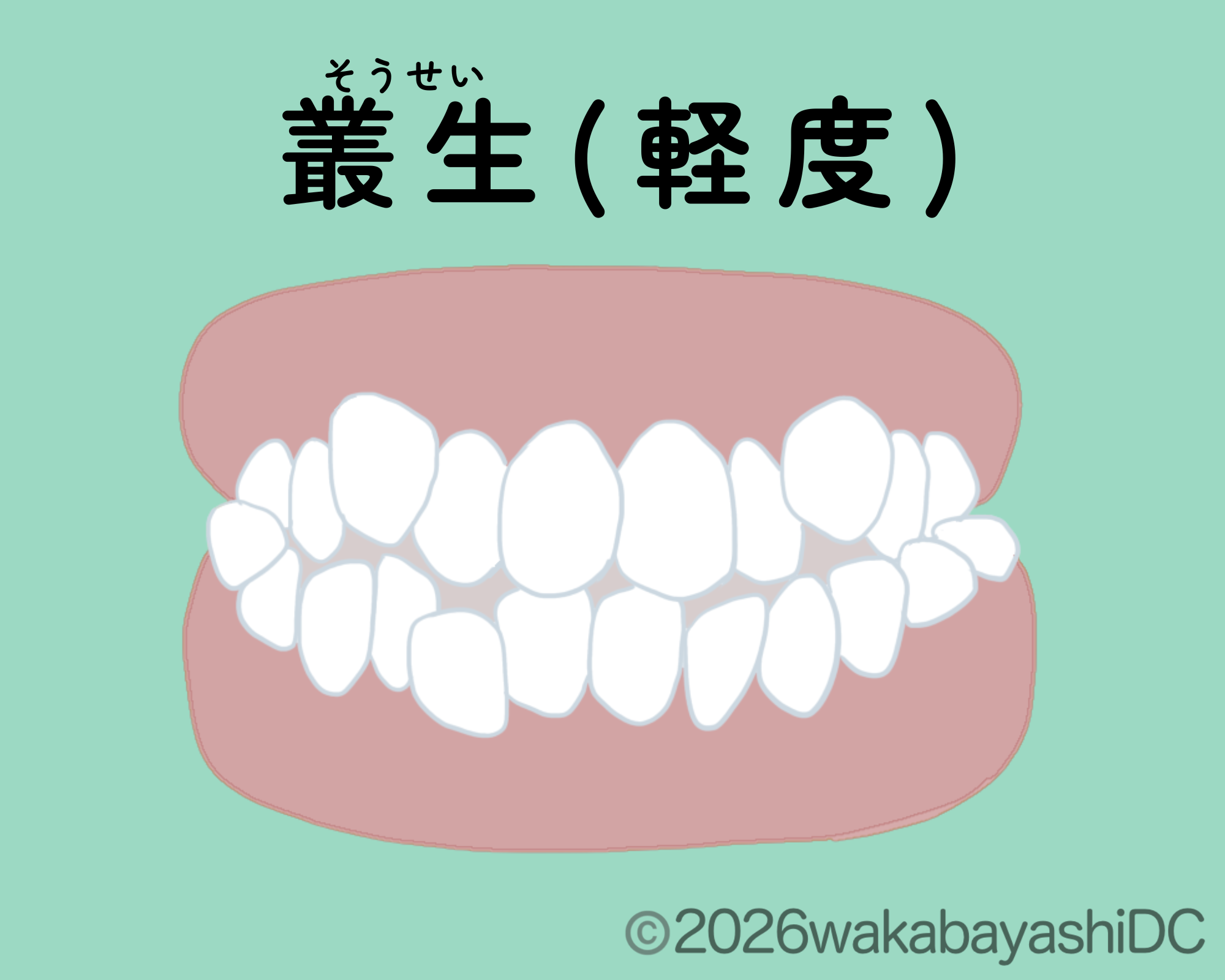マウスピース矯正で部分矯正