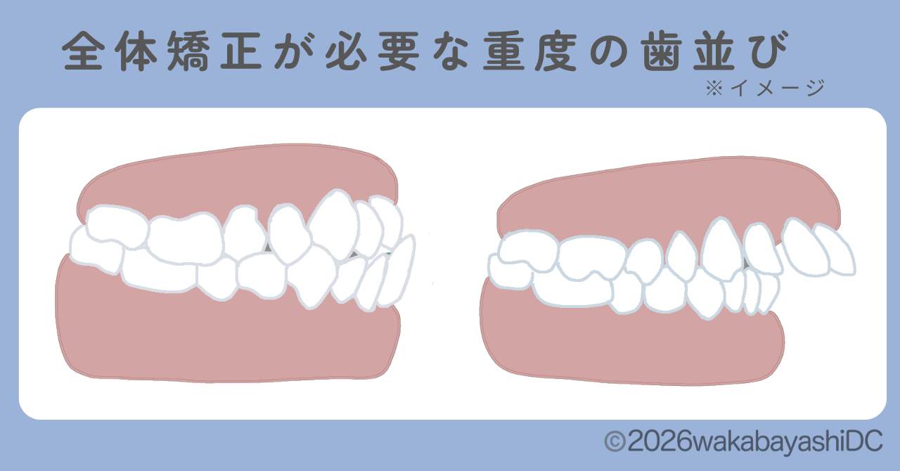 マウスピース矯正で部分矯正