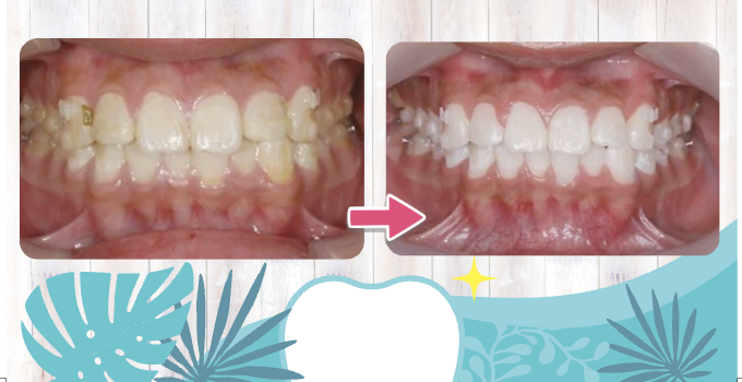 ホワイトニング