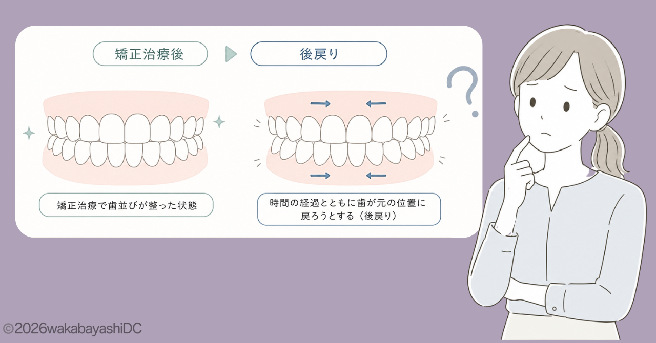 マウスピース矯正 元に戻る