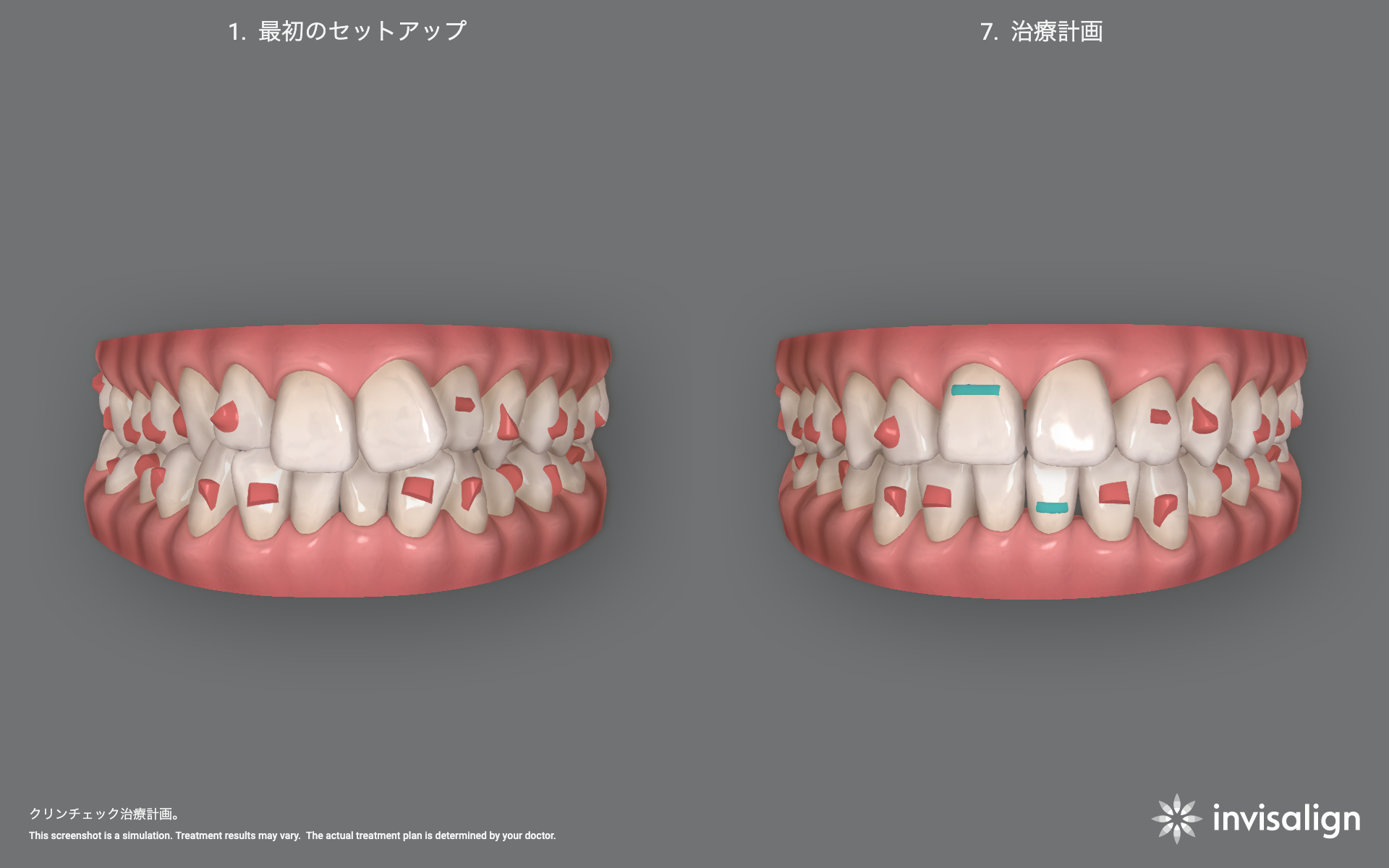 クリンチェック