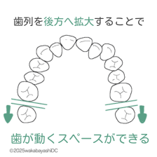 歯列を後方へ拡大