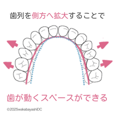 歯列が側方へ拡大