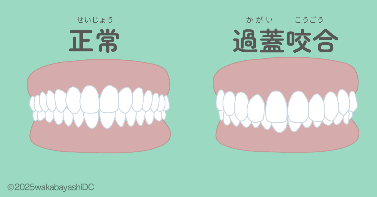 正常・過蓋咬合