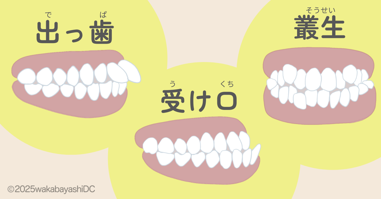 出っ歯受け口叢生