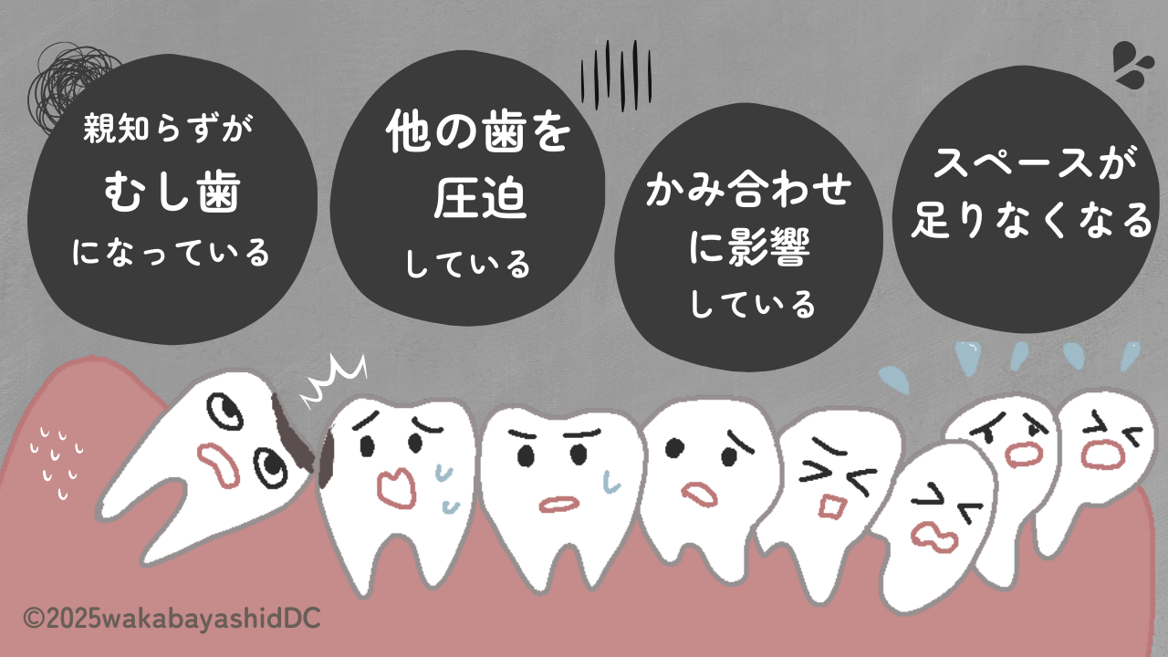 抜いたほうがいい親知らず