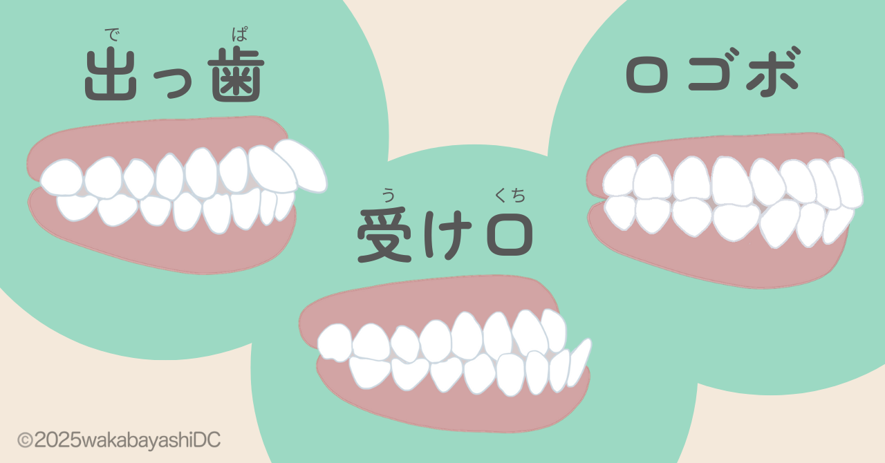 出っ歯受け口ロゴボ