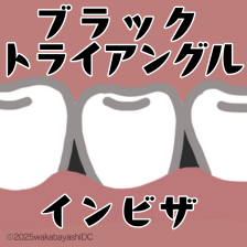 インビザラインでブラックトライアングルができる？原因やできた時の対処法