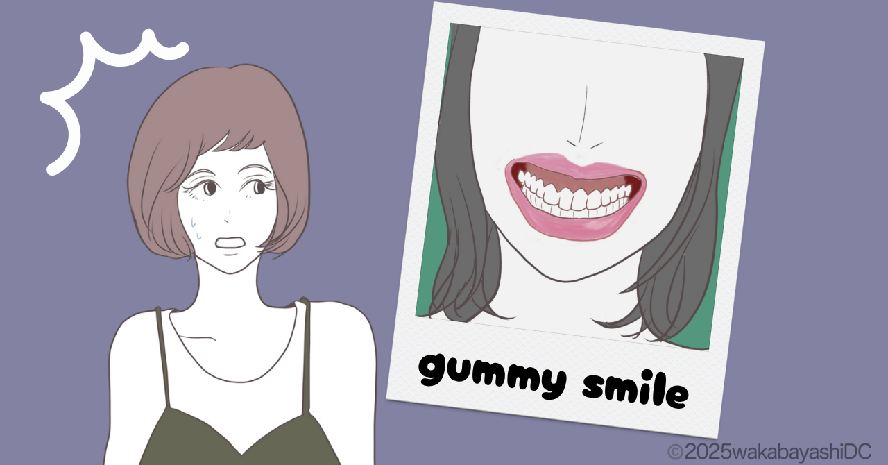 ガミースマイル