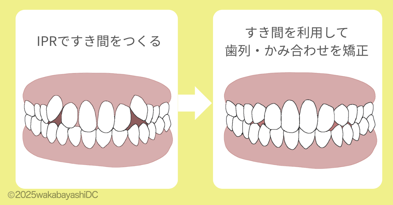 すき間を利用して歯列を整える