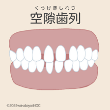 空隙歯列