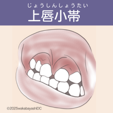 上唇小帯